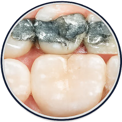 Teeth Whitening Federal Way