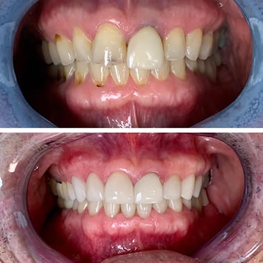 smile before and after 2